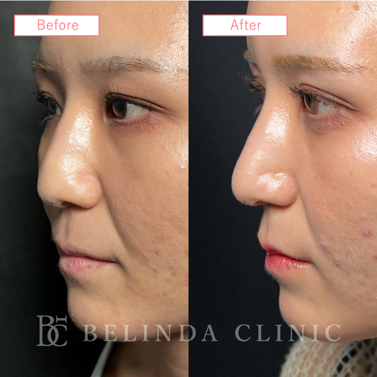 鼻中隔延長ビフォーアフターcase05