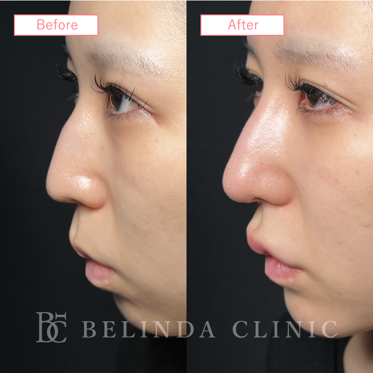 鼻中隔延長ビフォーアフターcase04