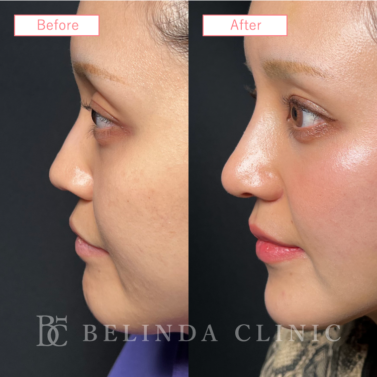 鼻中隔延長ビフォーアフターcase05