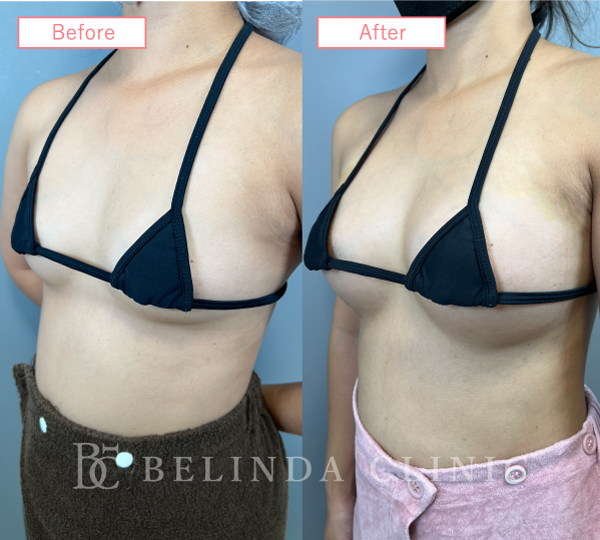 シリコンバッグ豊胸ビフォーアフターcase03