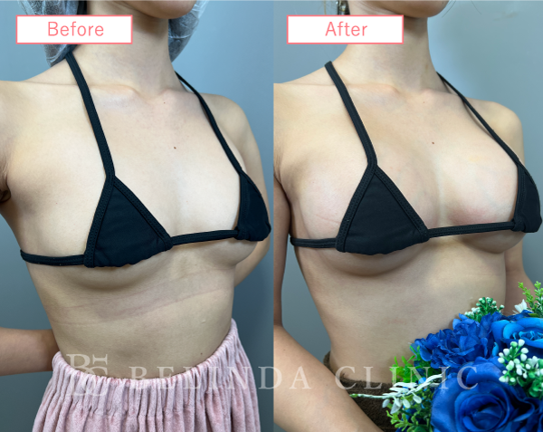 シリコンバッグ豊胸ビフォーアフターcase02