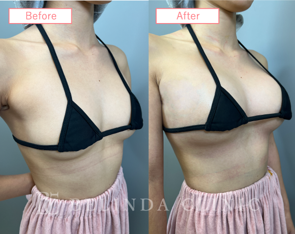 シリコンバッグ豊胸ビフォーアフターcase01