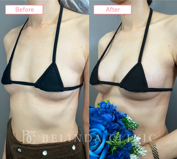 シリコンバッグ豊胸ビフォーアフターcase02