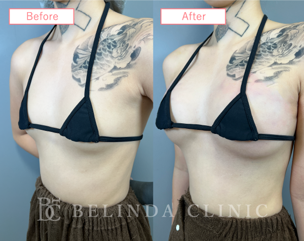 ハイブリット豊胸ビフォーアフターcase03