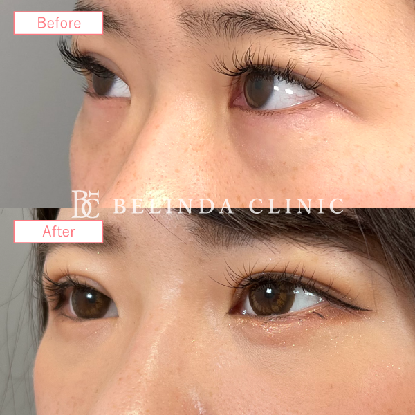 クマ取り症例No1411