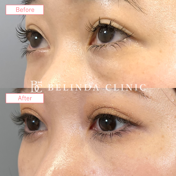 クマ取り症例No2015