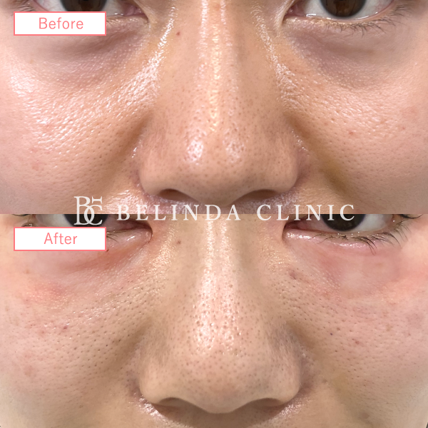 切らないクマ取り(裏ハムラ法)No5293