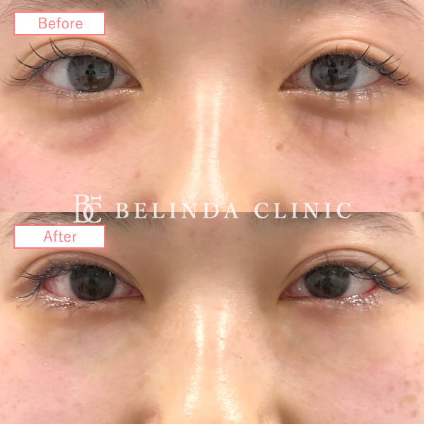 切らないクマ取り(裏ハムラ法)No5422