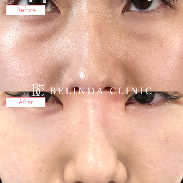 岡山院切らないクマ取り裏ハムラ法症例