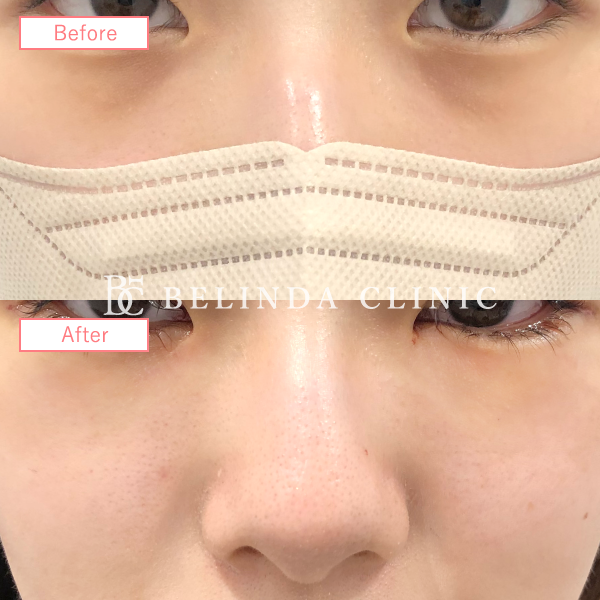 切らないクマ取り(裏ハムラ法)No5483