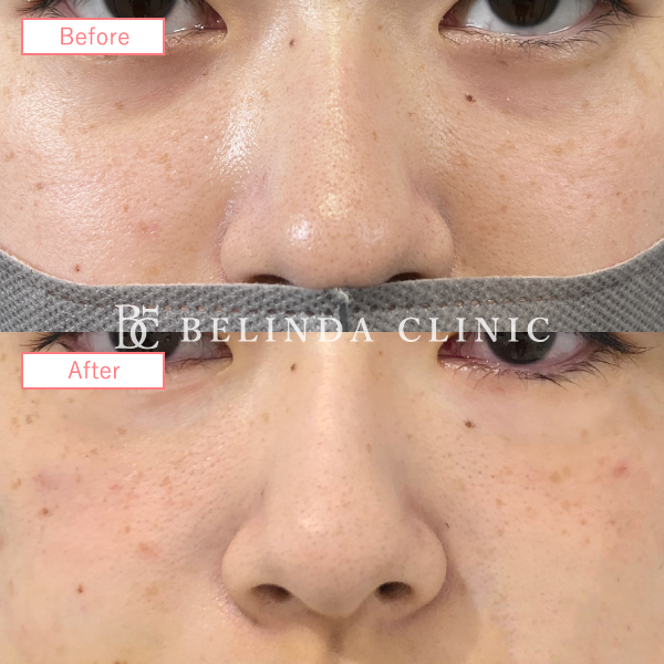 切らないクマ取り(裏ハムラ法)No5494