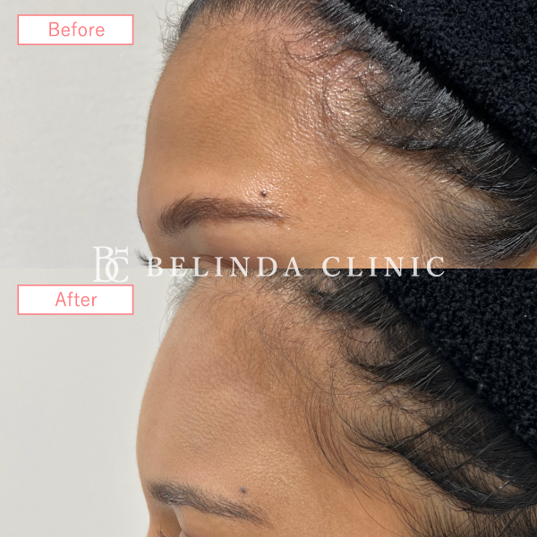 形成ヒアルロン酸No1096