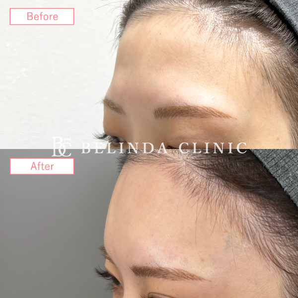 形成ヒアルロン酸No1146