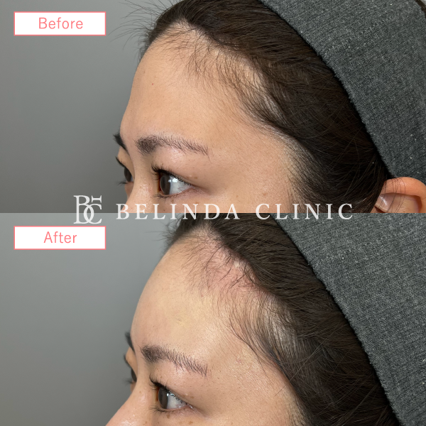 形成ヒアルロン酸No1633