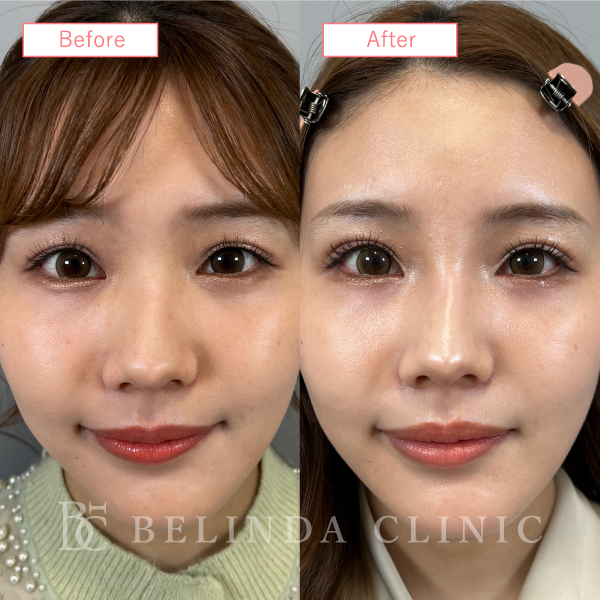 鼻ヒアルロン酸No1837