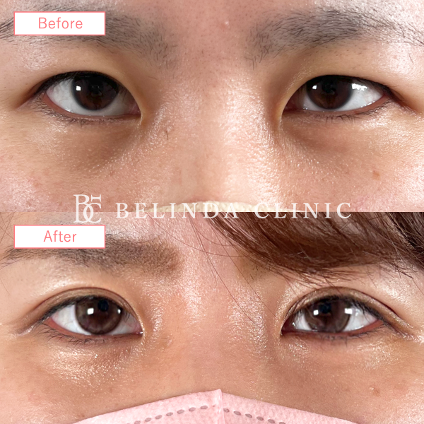 二重整形埋没法No195