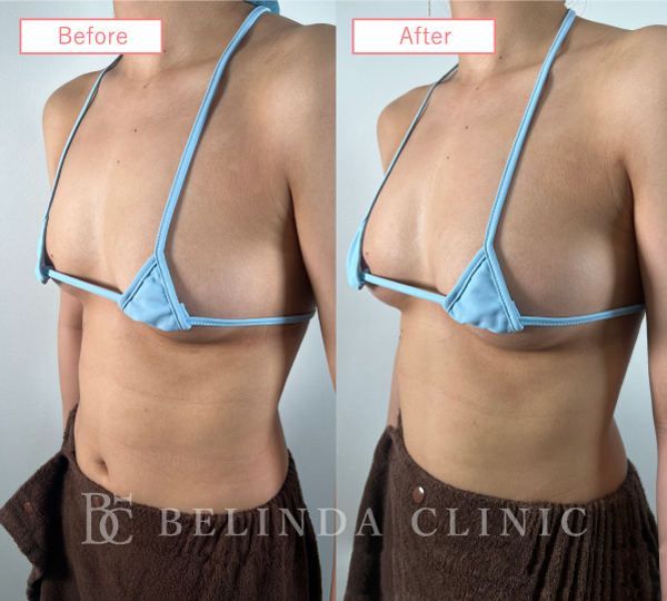 脂肪豊胸症例No204