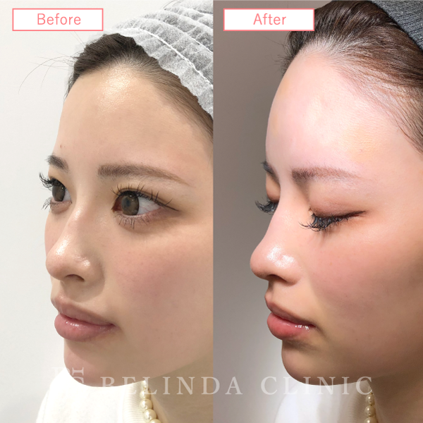 形成ヒアルロン酸No2216