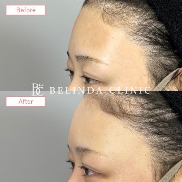 形成ヒアルロン酸No2271