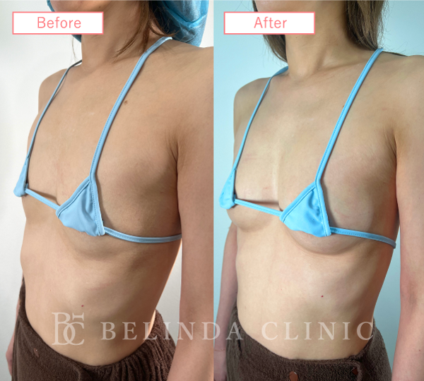 脂肪豊胸症例No260_1