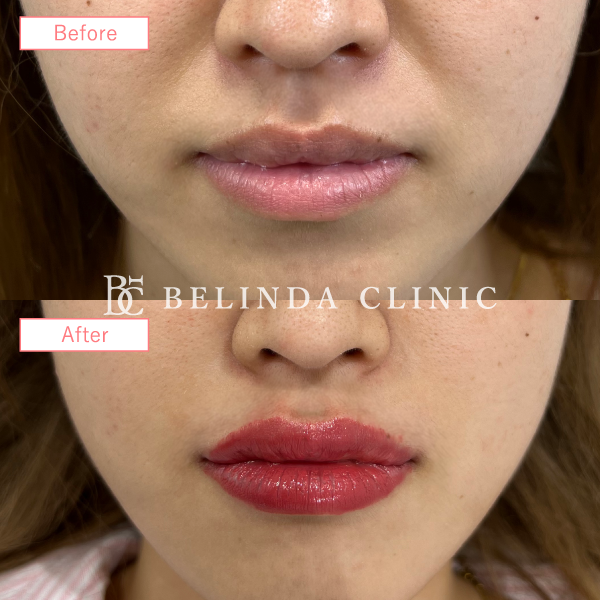 唇ヒアルロン酸No2675