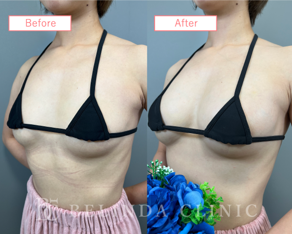 脂肪豊胸症例No2990