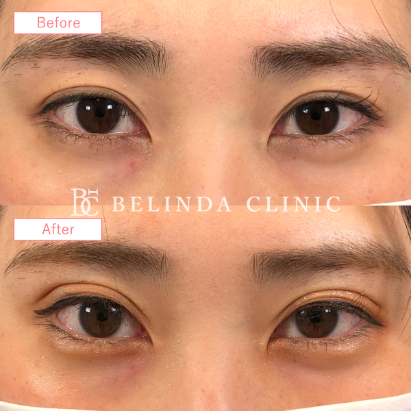 涙袋ヒアルロン酸No3085