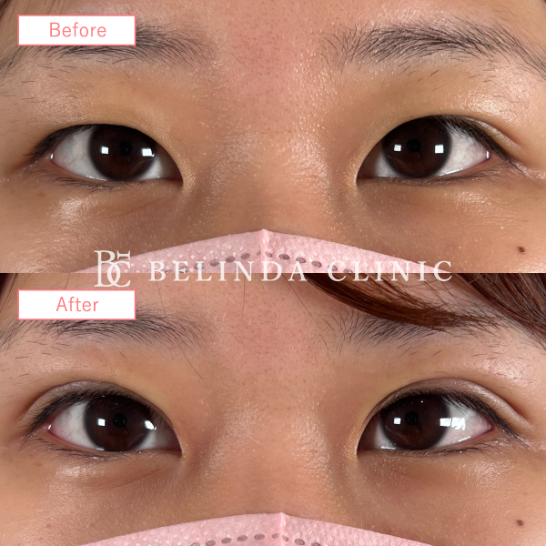 二重整形埋没法No347