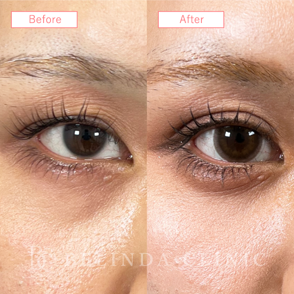 目上切開症例No3661