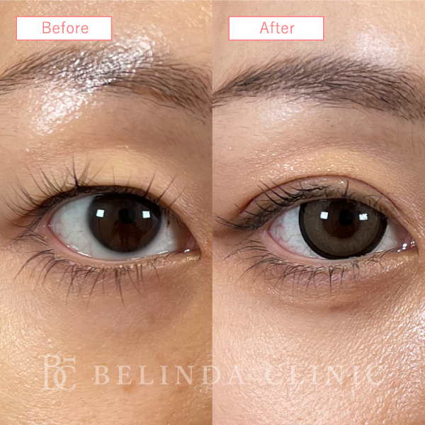 目上切開法ビフォーアフターcase03