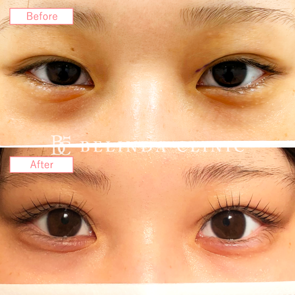 涙袋ヒアルロン酸No3834