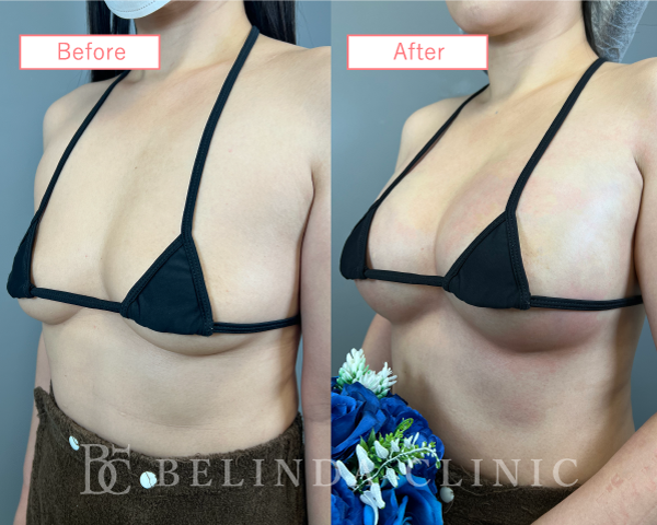 脂肪豊胸症例No4517