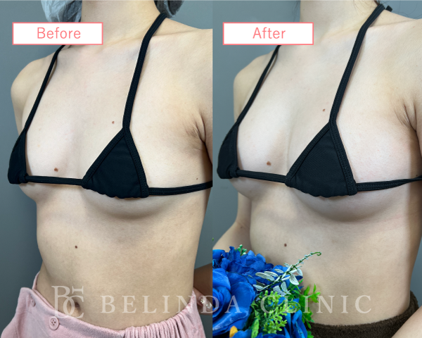 脂肪豊胸症例No4542