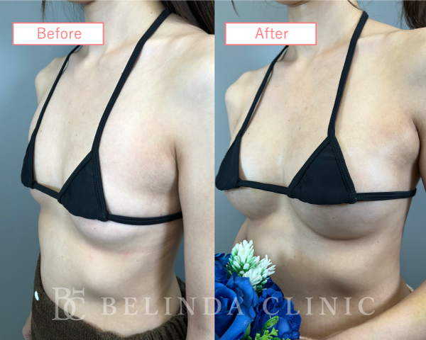 脂肪注入豊胸症例18