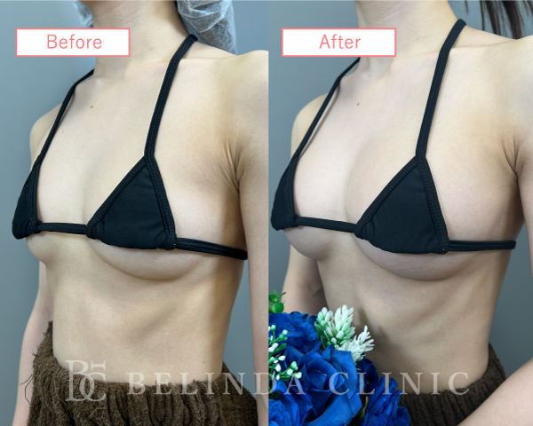 脂肪注入豊胸症例08