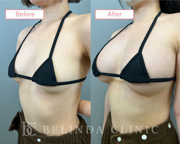 ハイブリット豊胸ビフォーアフターcase04