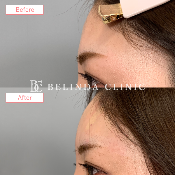 形成ヒアルロン酸No87