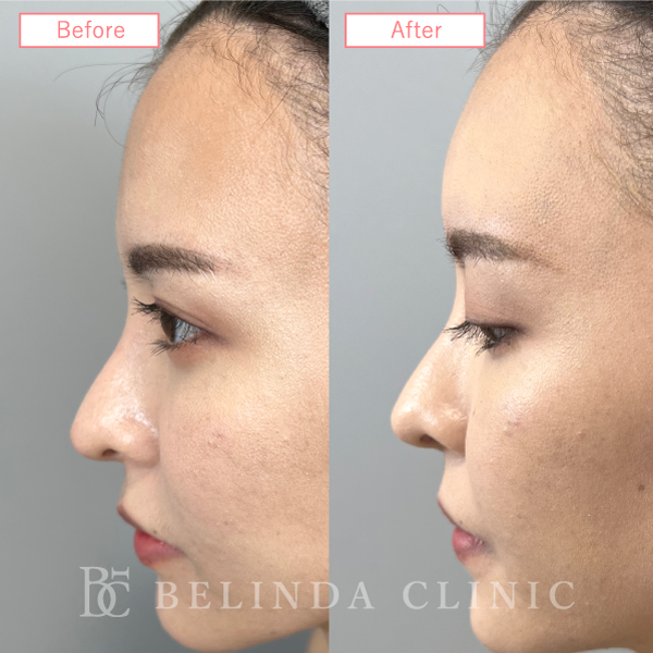 形成ヒアルロン酸No91