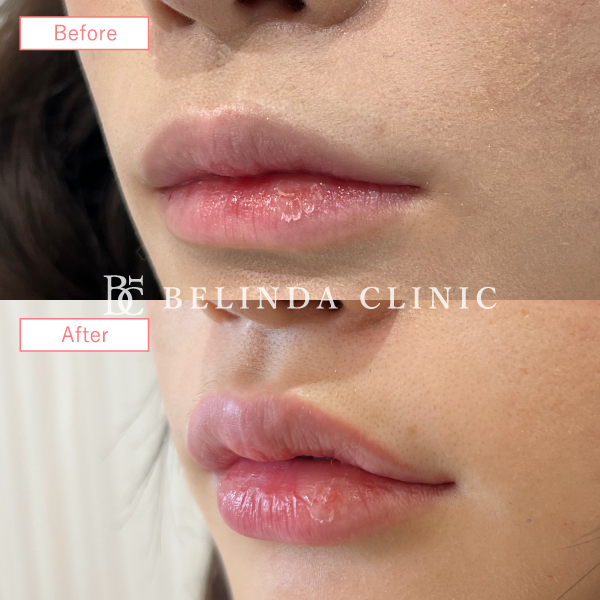 唇ヒアルロン酸No93