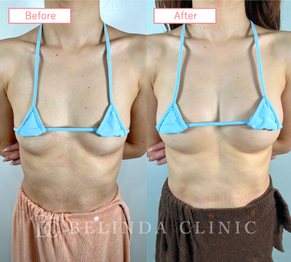 脂肪豊胸症例No94_1