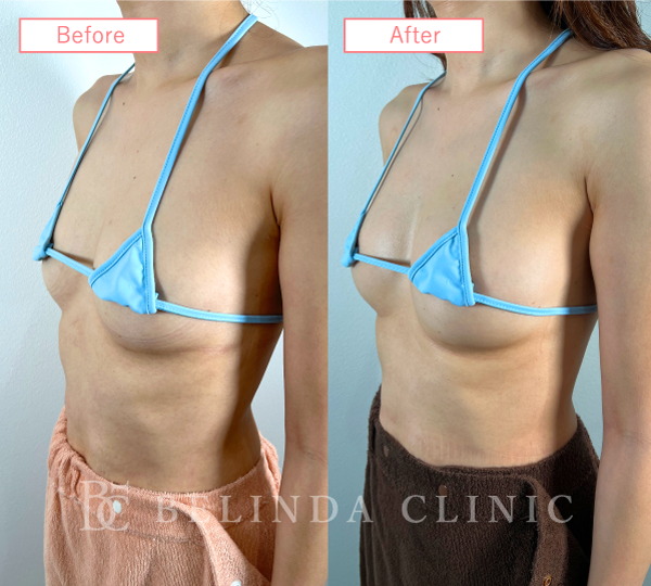 脂肪豊胸症例No94_2