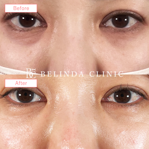 クマ取り症例No16