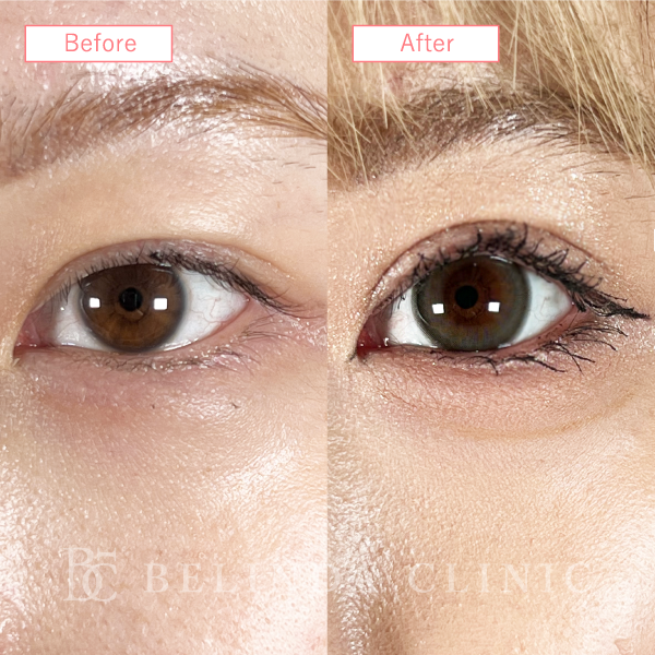 二重整形切開法No399