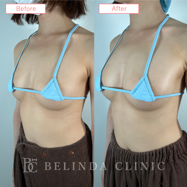 ヒアルロン酸豊胸No491