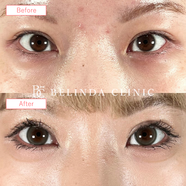 二重整形切開法20240721