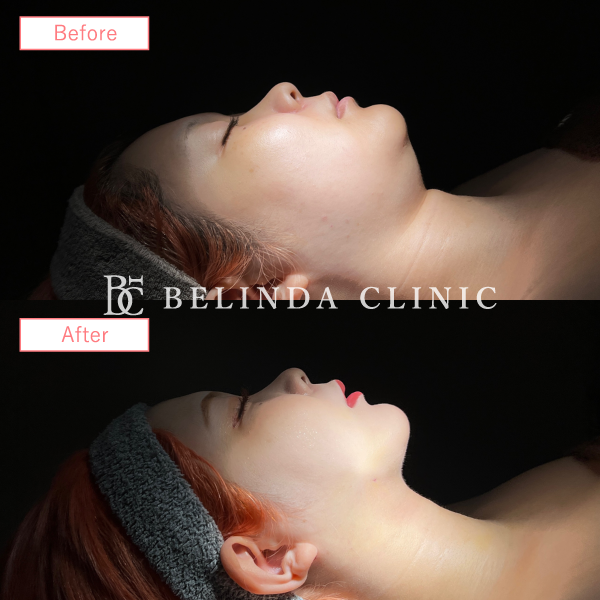 小顔脂肪吸引(頬・顎下)case01