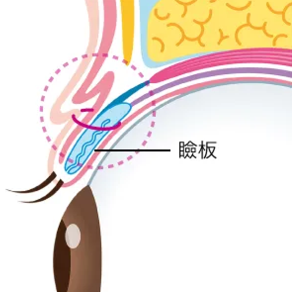 二重埋没法施術方法イラスト