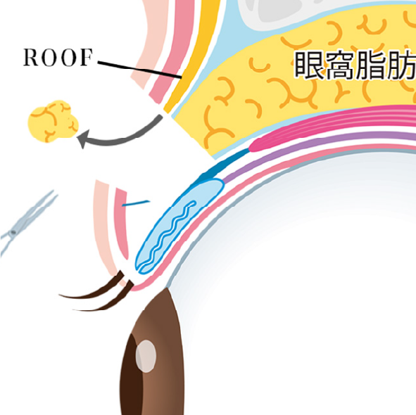 二重切開法施術方法イラスト