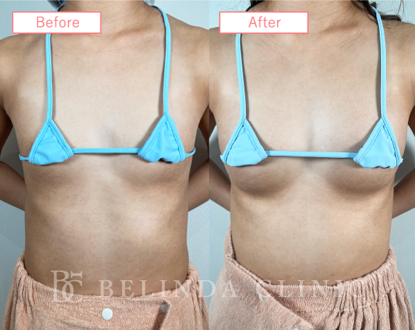 脂肪豊胸症例No100