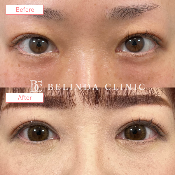 二重整形埋没法症例No1774